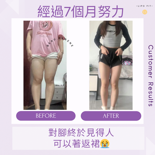 顧客效果：食左7個月對腳大改造，終於可以著返裙！